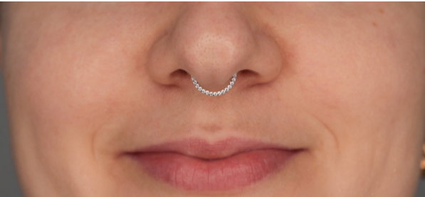 Иллюстрация прокола Септум