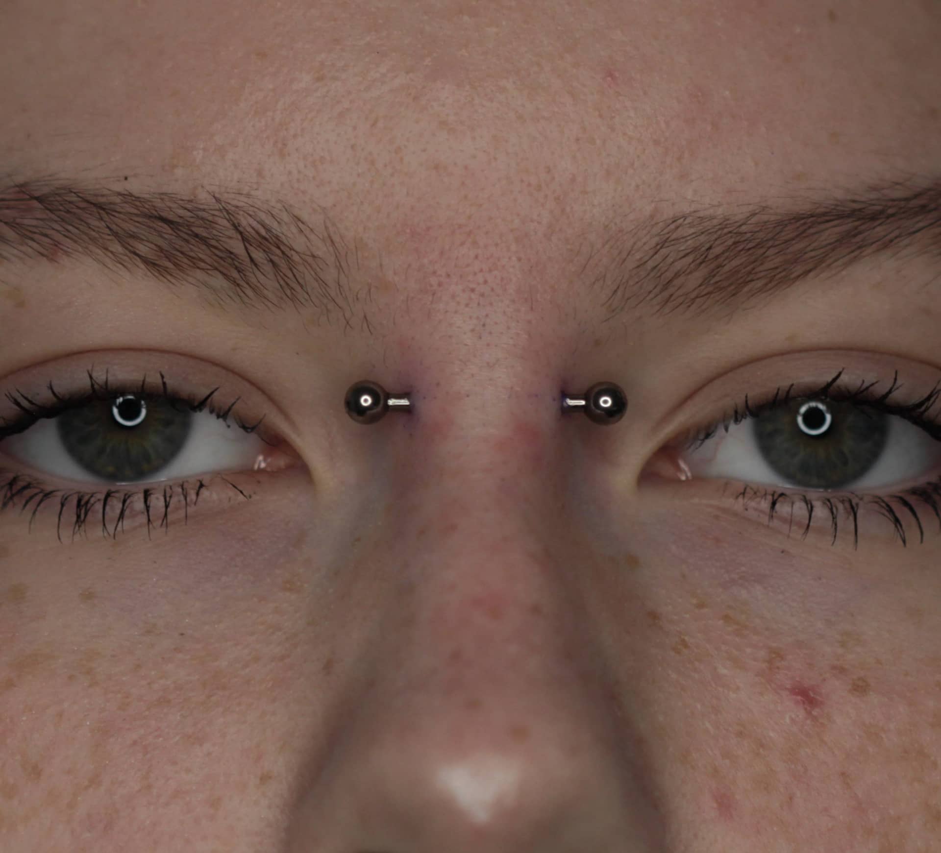 Иллюстрация прокола Бридж